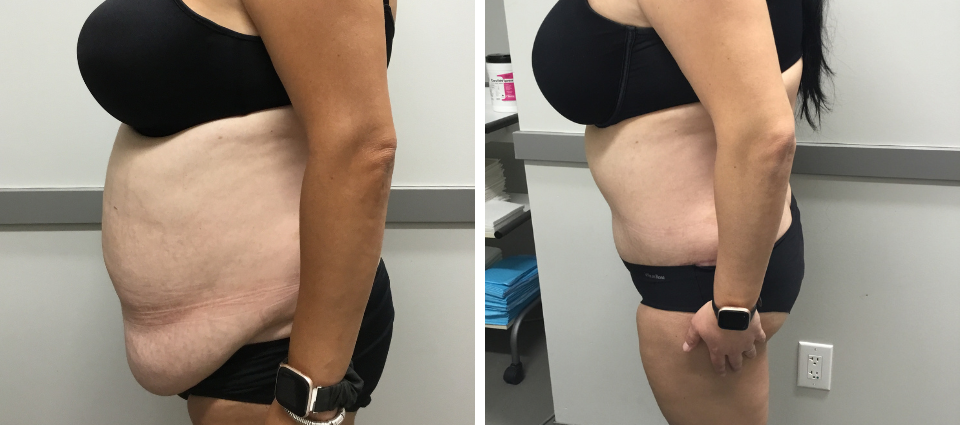 Brazilian Butt Lift for Brampton & Toronto – Mississauga Cosmetic Surgery &  Laser Clinic