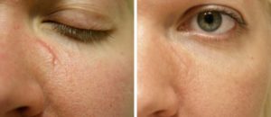 What Is a ProFractional Laser Skin Treatment?