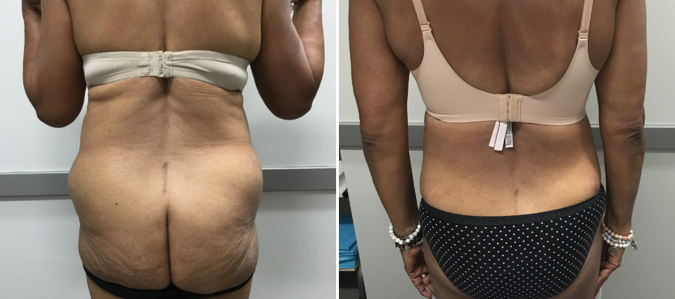 Gaining Weight After A Tummy Tuck – Mississauga Cosmetic Surgery